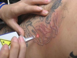 tatto removal